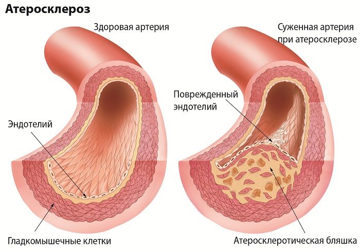 Гіперглікемія — не вирок! » журнал здоров'я iHealth 9