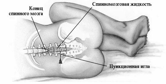 Що таке синдром Уотерхауса-Фрідеріксена? » журнал здоров'я iHealth 4